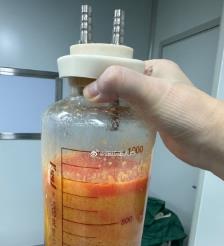 三沙水动力吸脂手术要做多久？